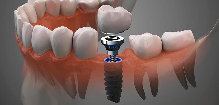 Implantología Dental: Nuevas Fronteras